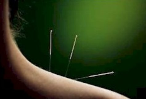 Acupuncture Provides True Pain Relief in Study