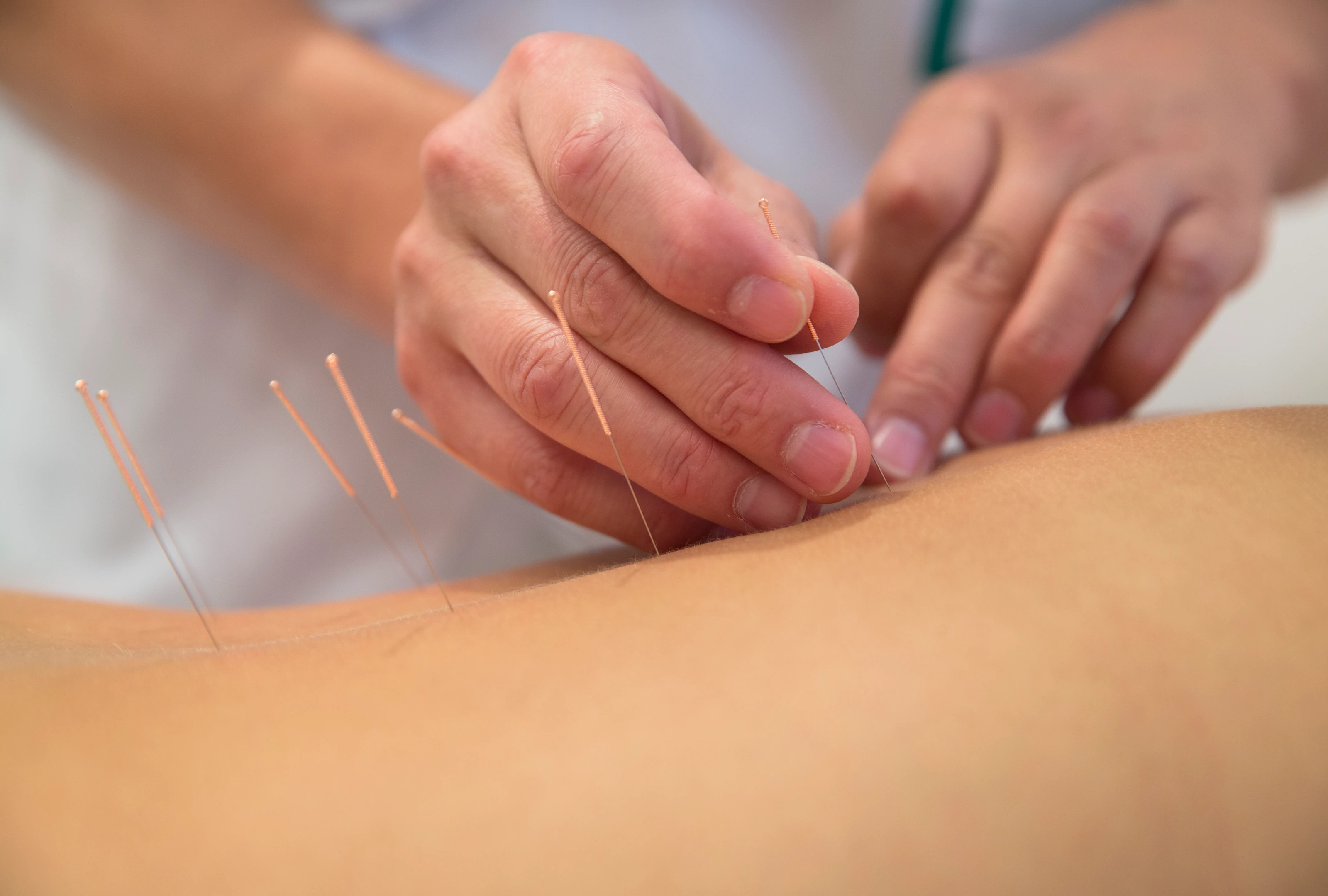 82e73003-2386-4aa8-975b-2d83aed2752d 1 (10) A person is using acupuncture needles on the back of another person.