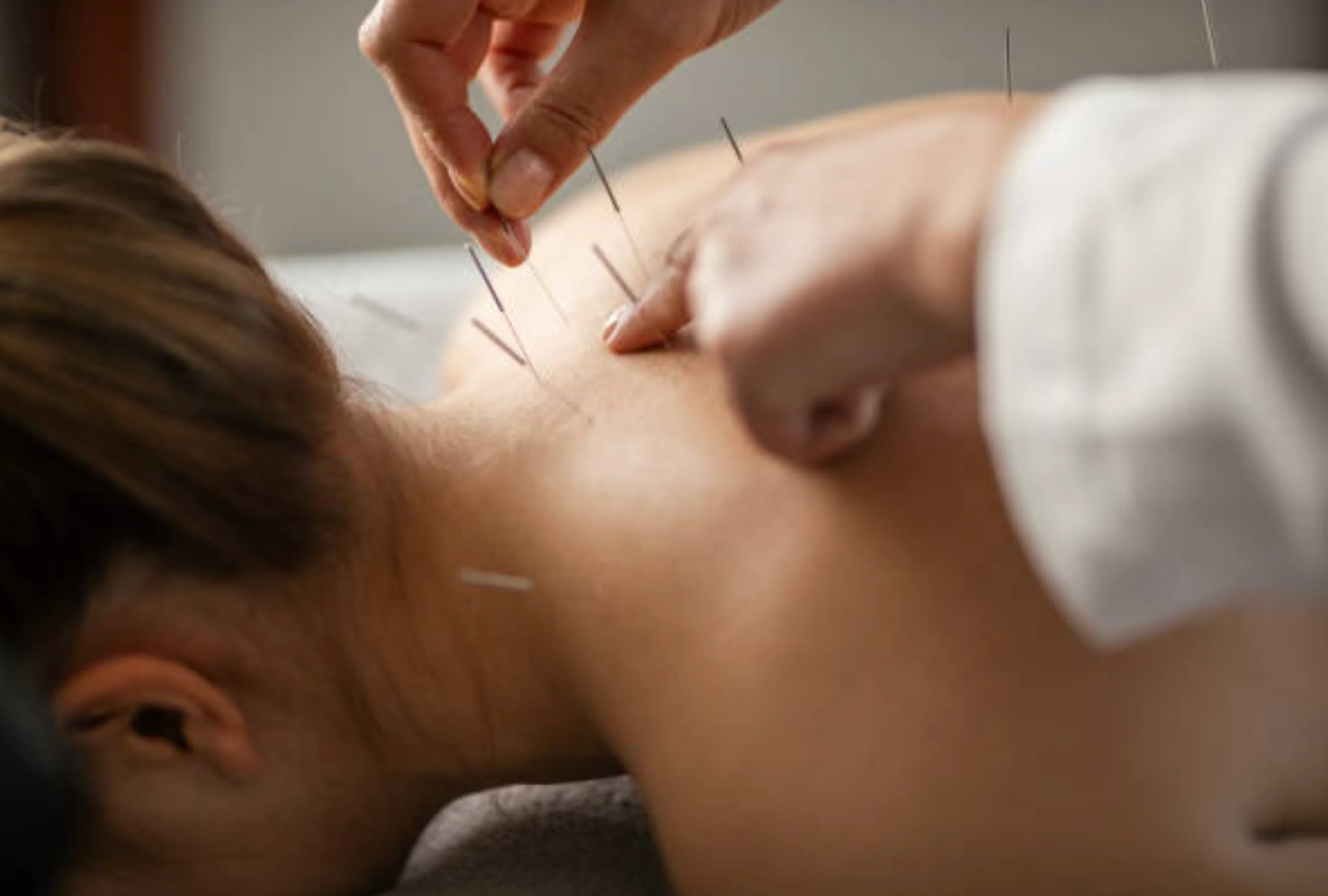 82e73003-2386-4aa8-975b-2d83aed2752d 1 (8) A person is getting acupuncture on her back.