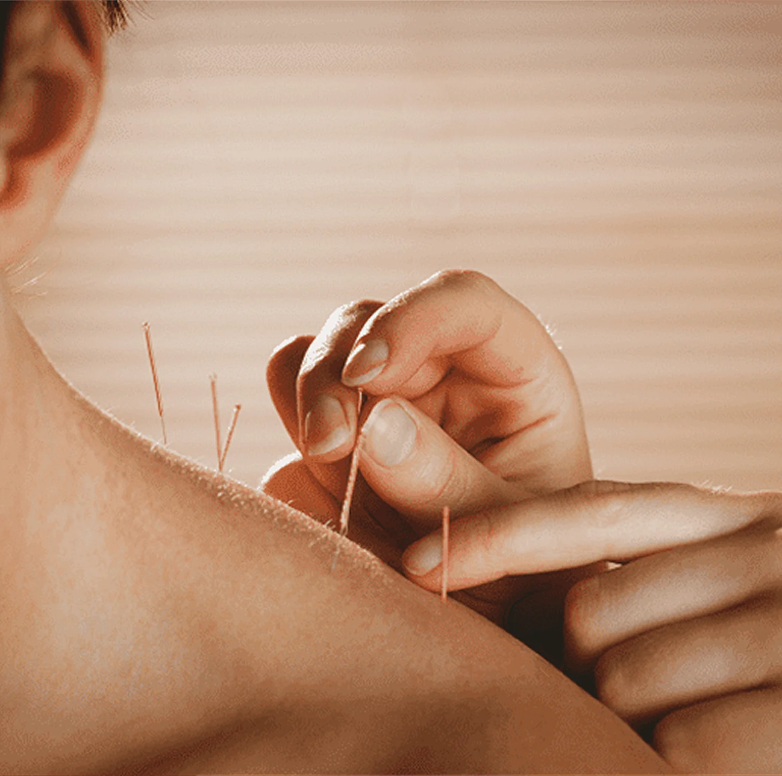 3-3-5 A person is holding onto acupuncture needles
