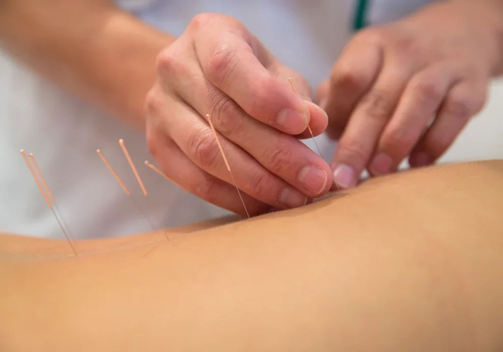 82e73003-2386-4aa8-975b-2d83aed2752d 1 (10) A person is using acupuncture needles on the back of another person.