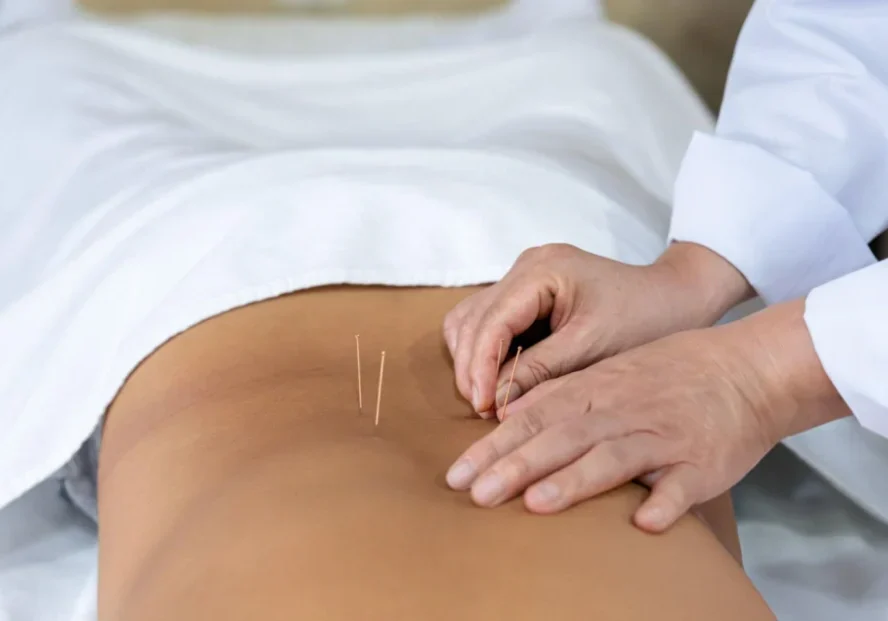 New Project A person is using acupuncture needles on the back of their body.
